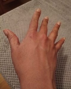 Hand opens after 4 weeks