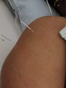 acupuncture on shoulder